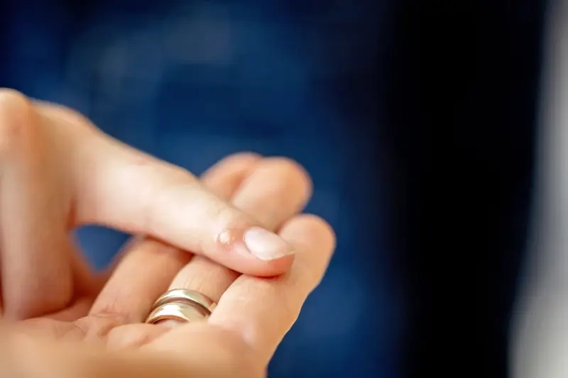 Co dobre na kurzajki?